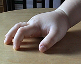 Oesterreicht-News-247.de - sterreich Infos & sterreich Tipps | HAE - Schwellung der Hand