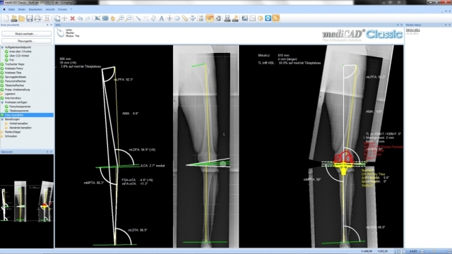 Europa-247.de - Europa Infos & Europa Tipps | Das Bild zeigt die Planung einer Knie-Endoprothetik.
