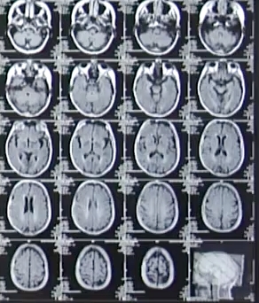 Deutsche-Politik-News.de | Mit der Magnetresonanztomographie (MRT) untersuchen Kliniker das Gehirn schmerzfrei. (Foto: J. Wolff / MEDIZIN ASPEKTE)
