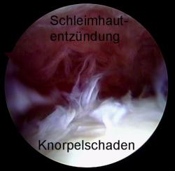 SeniorInnen News & Infos @ Senioren-Page.de | Foto: Ein Sturz auf die Hfte kann zu Einreien des Knorpels im Hftgelenk fhren, wie diese Arthroskopie zeigt. Unerkannt kann das zu schwerer Hft-Arthrose fhren. Quelle: www.gelenk-doktor.de.